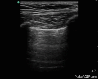 Diagnosing_Pneumothorax_on_Ultrasound